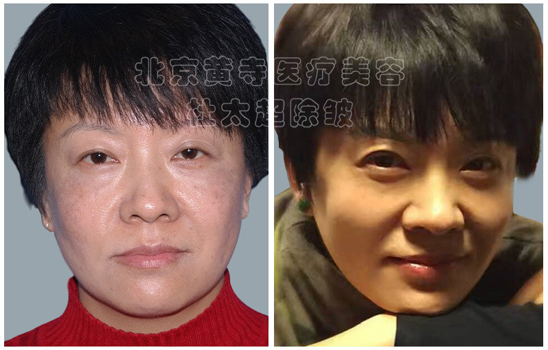 眼袋去除术后对比