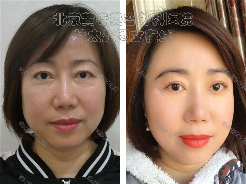 眼袋去除术后对比