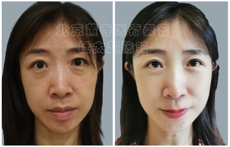 眼袋去除术后对比