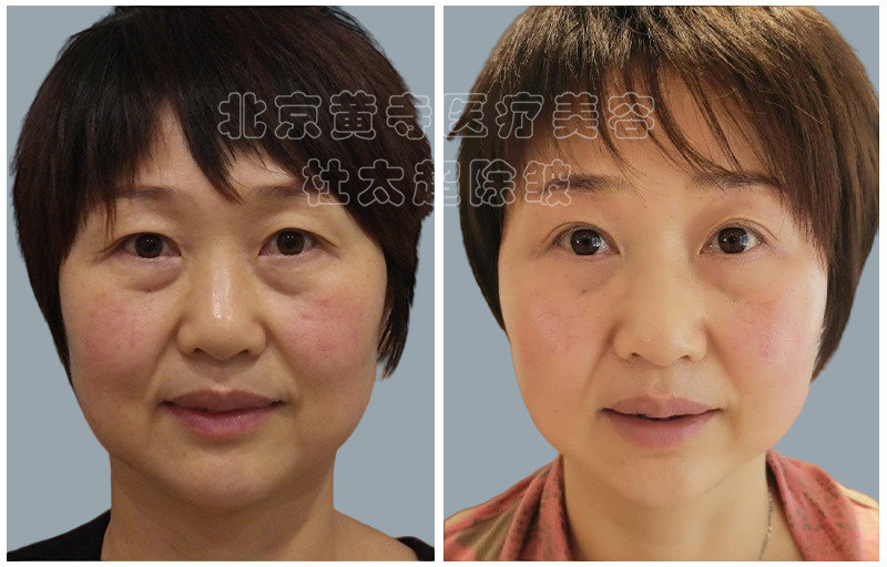 眼袋去除术后对比