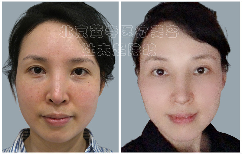 眼袋去除术后对比