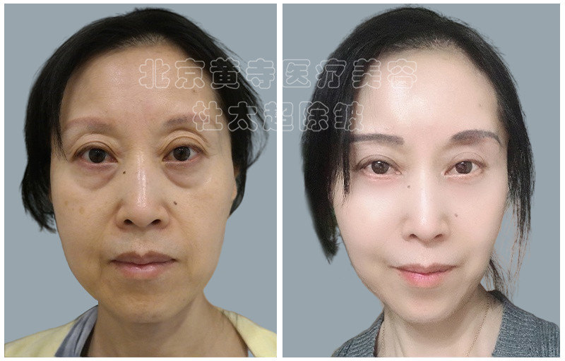 眼袋去除术后对比