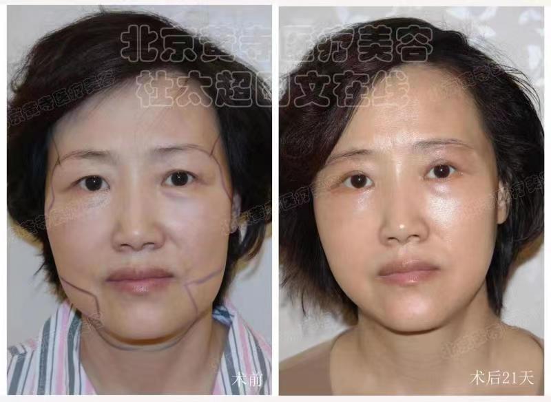 眼袋去除术后对比