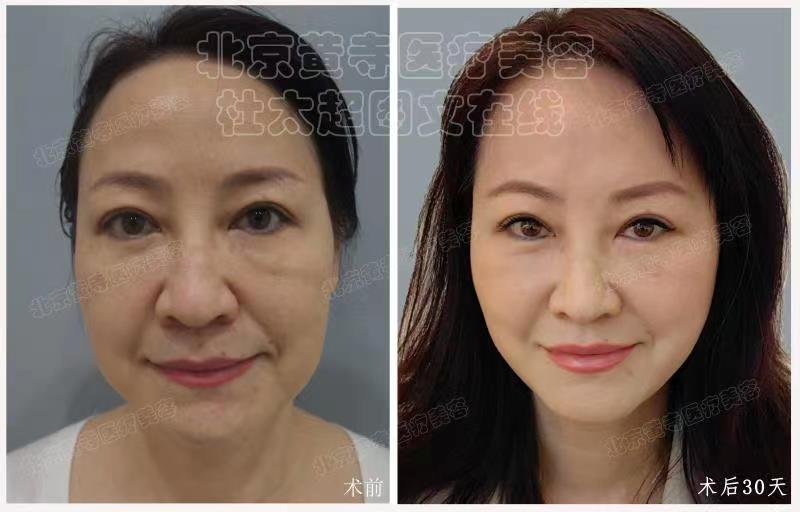 眼袋去除术后对比