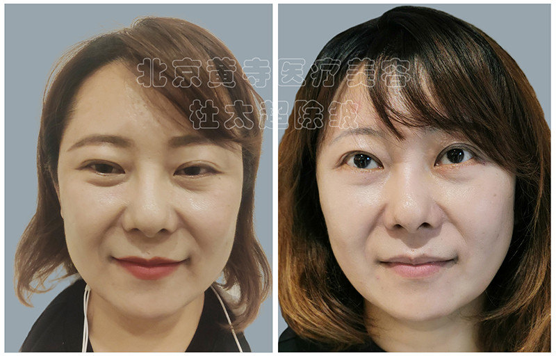 眼袋去除术后对比