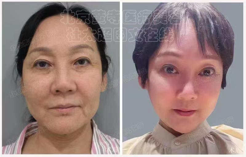 眼袋去除术后对比