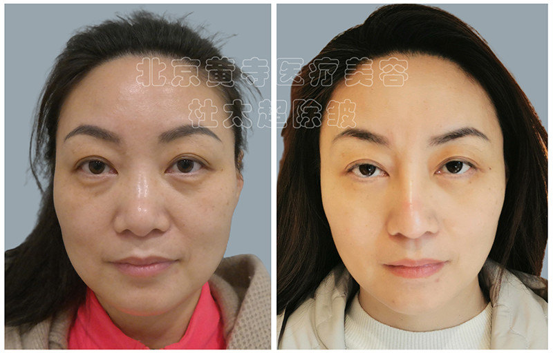 眼袋去除术后对比