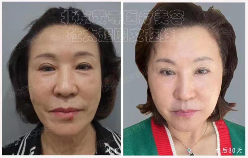 眼袋去除术后对比