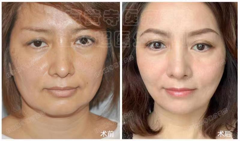 眼袋去除术后对比