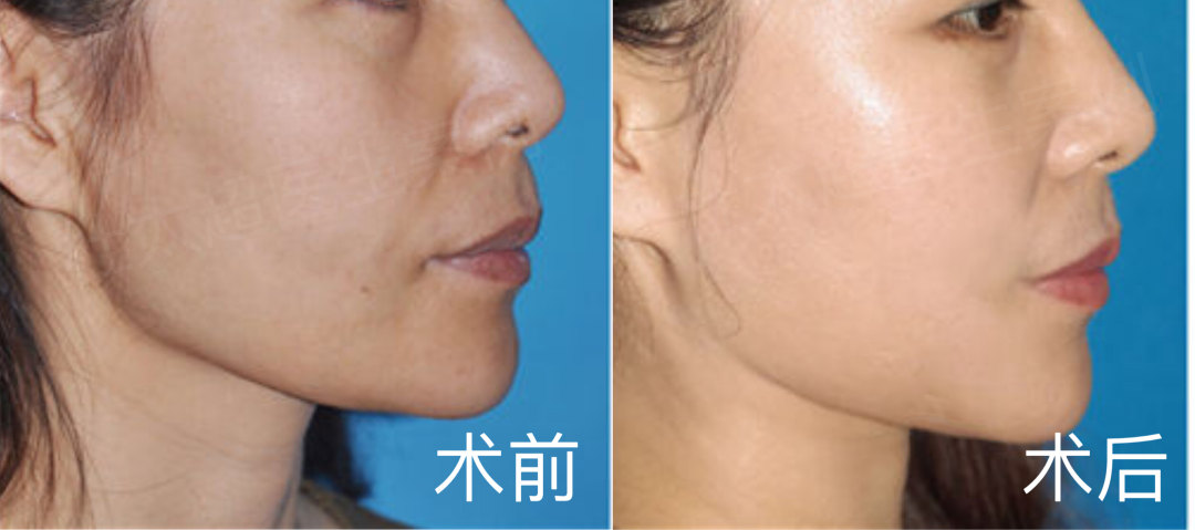 小切口的远期效果到底如何呢？