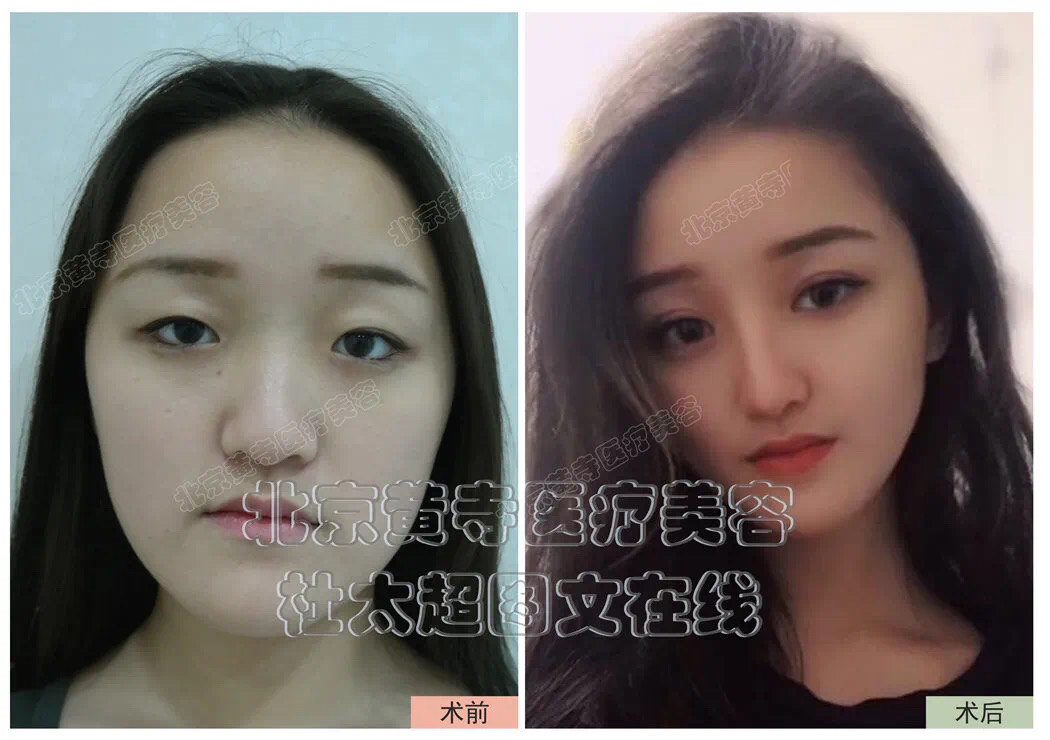 双眼皮真的就这么简单吗？