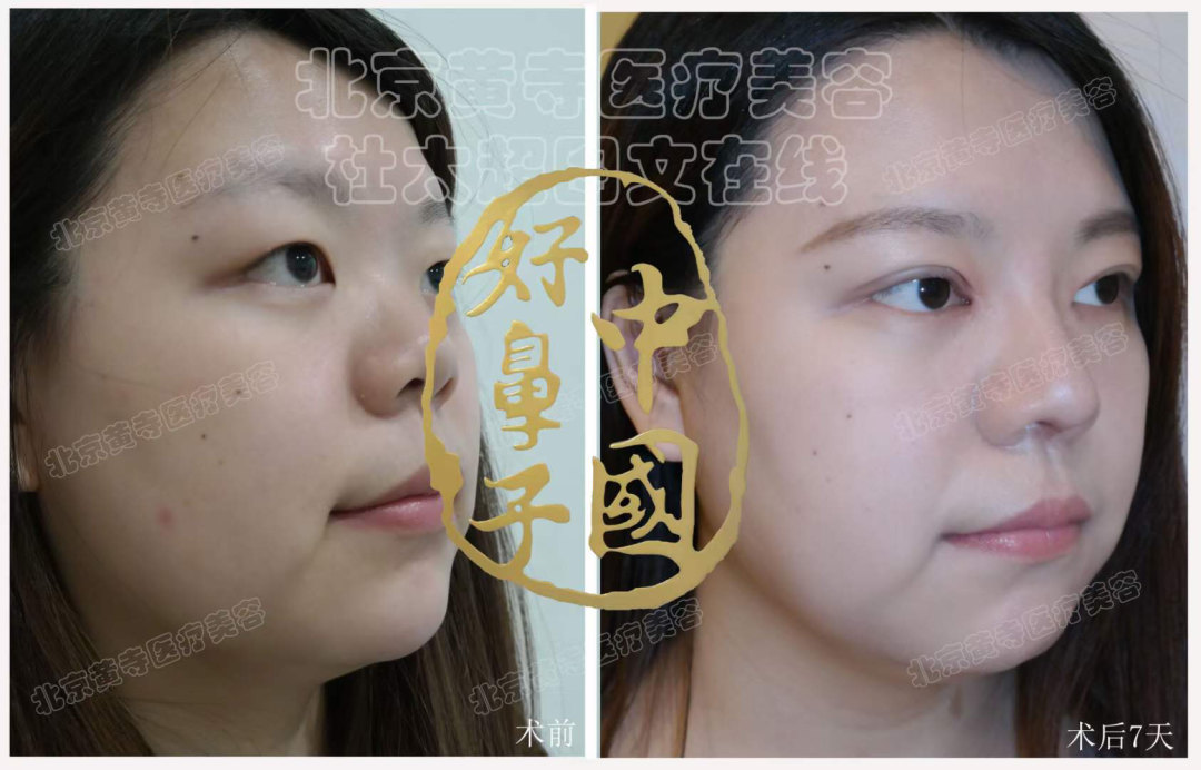 注射隆鼻和假体隆鼻该如何选择呢？