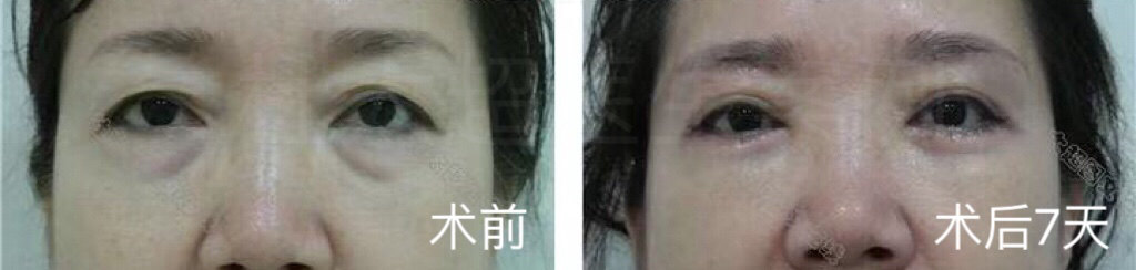 多重睑的“烦恼”，您有吗？