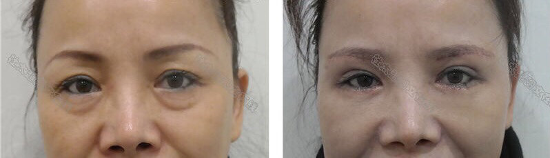 什么人适合做提眉术？