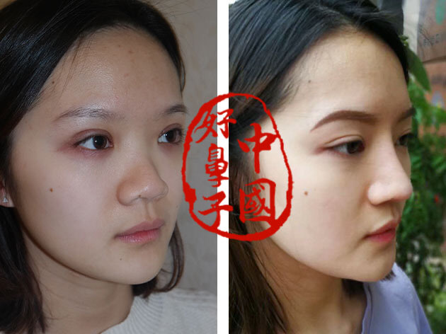 原来鼻翼缩小后可以这么美！