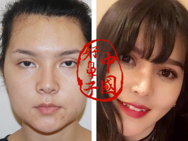 鼻整形看起来很假的原因