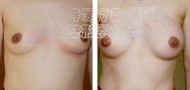 求美者假体隆胸