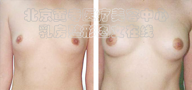 求美者假体隆胸