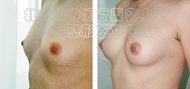 求美者假体隆胸