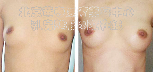 求美者假体隆胸