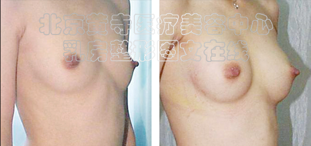 求美者假体隆胸