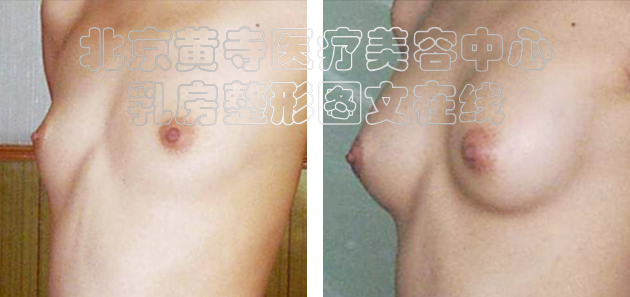 求美者假体隆胸