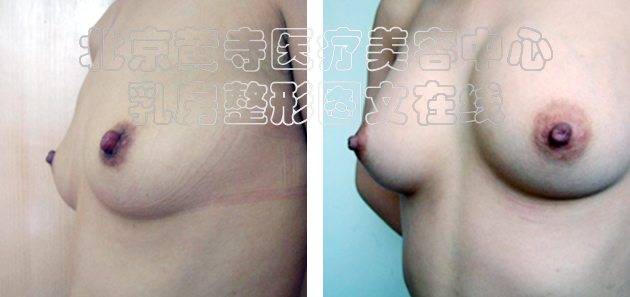 求美者假体隆胸