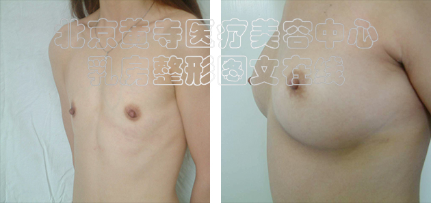 求美者假体隆胸