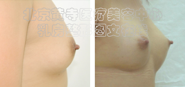 求美者假体隆胸