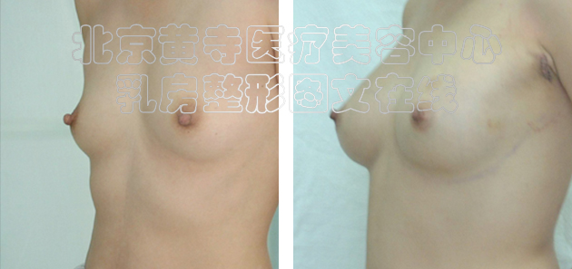 求美者假体隆胸