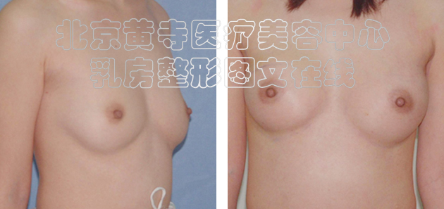 求美者假体隆胸