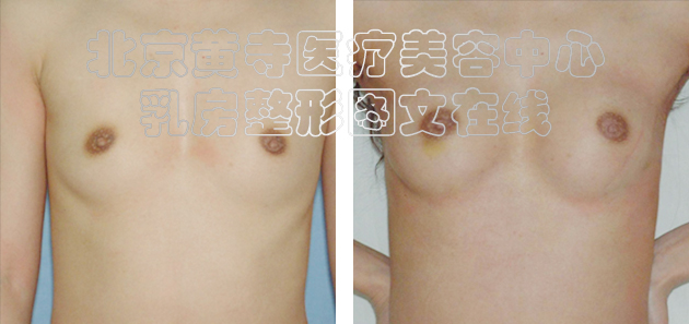 求美者假体隆胸