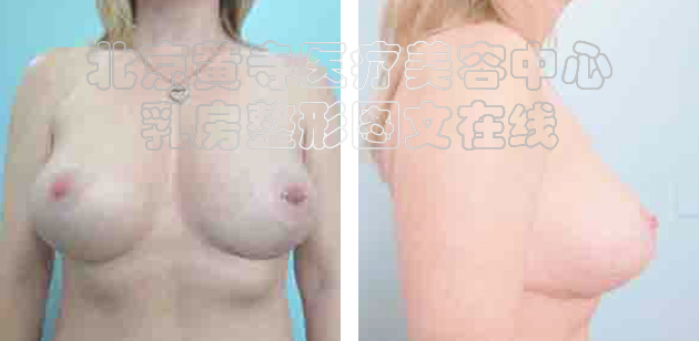 求美者缩胸手术