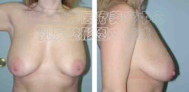 求美者缩胸手术
