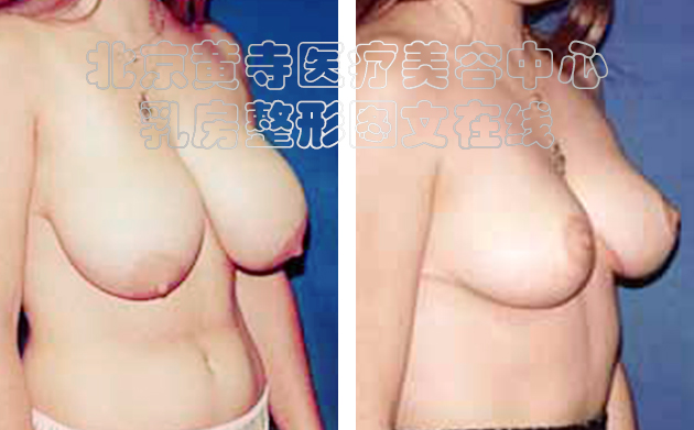 求美者缩胸手术