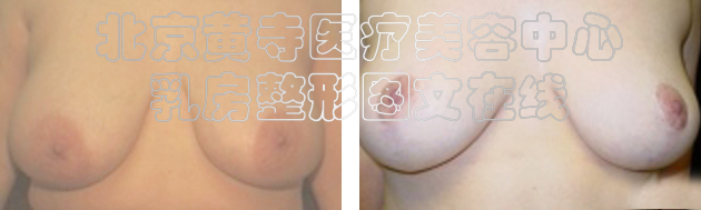 求美者缩胸手术