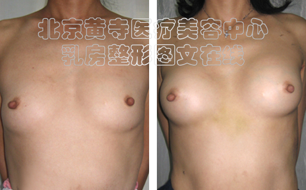 求美者假体隆胸