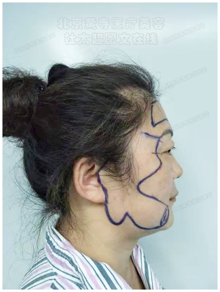 全脸拉皮切口
