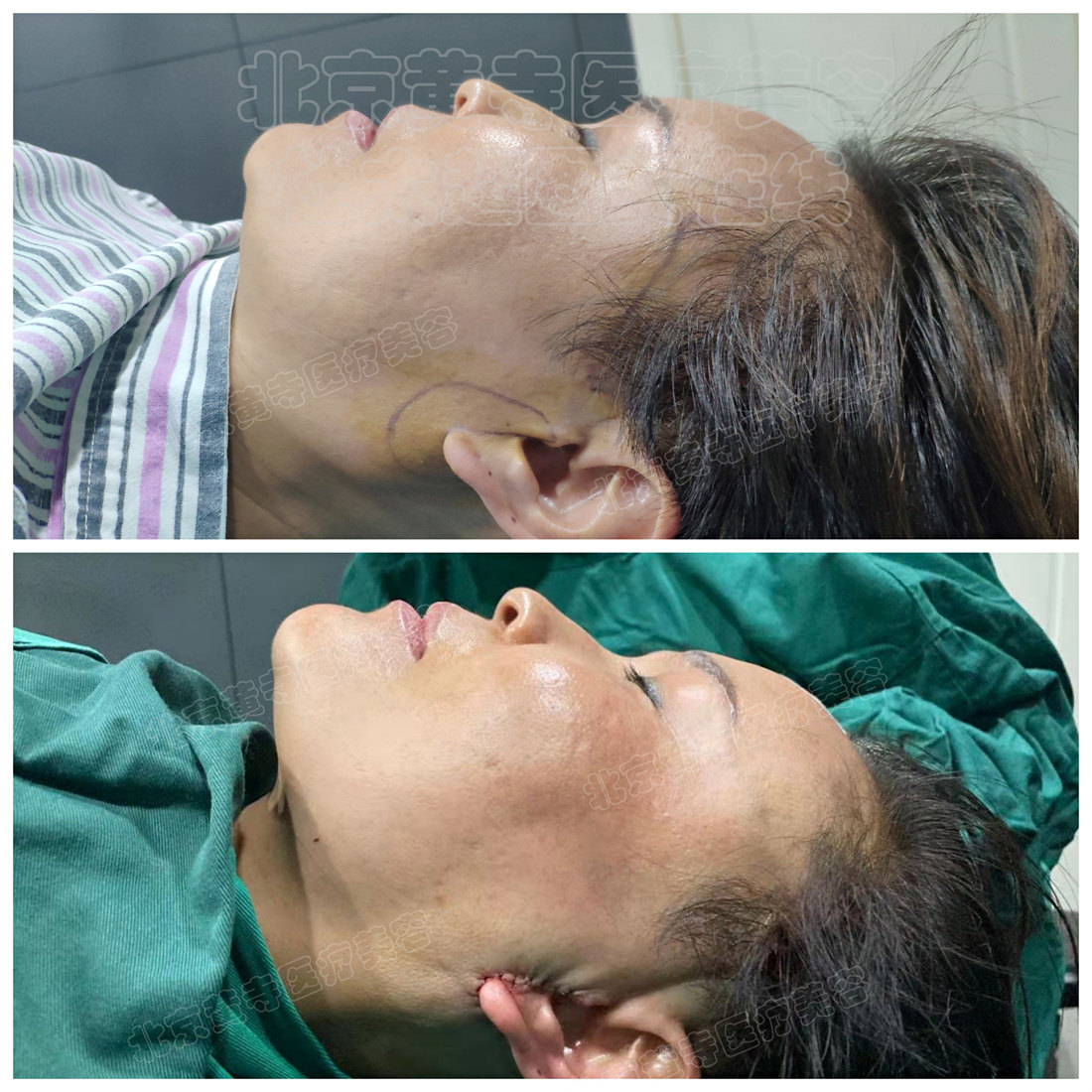 术前vs术后即刻