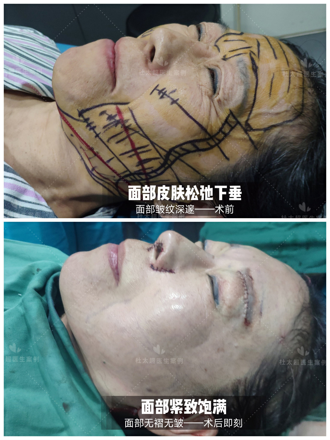 术前vs术后即刻