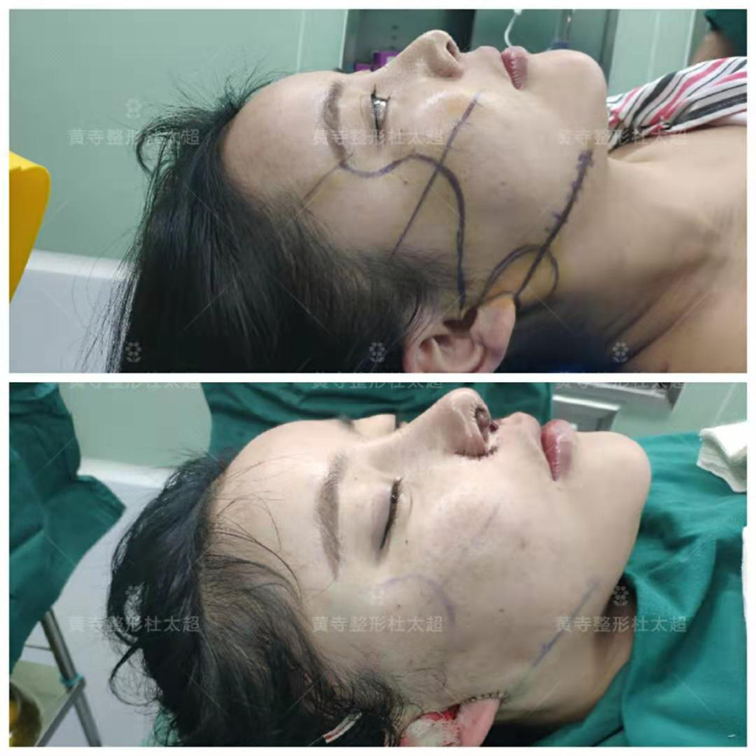 术前vs术后即刻