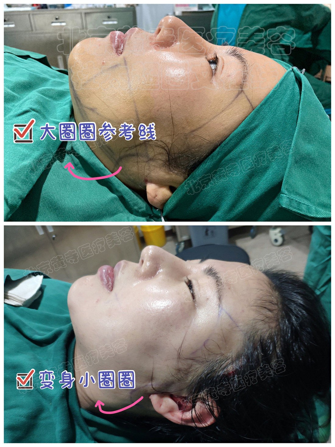 术前vs术后即刻