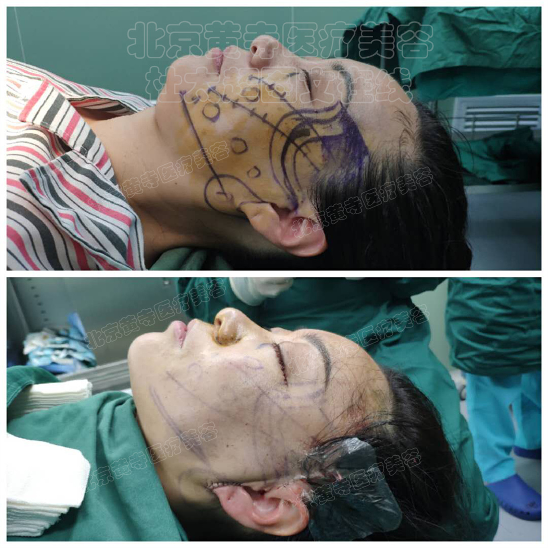 术前vs术后即刻