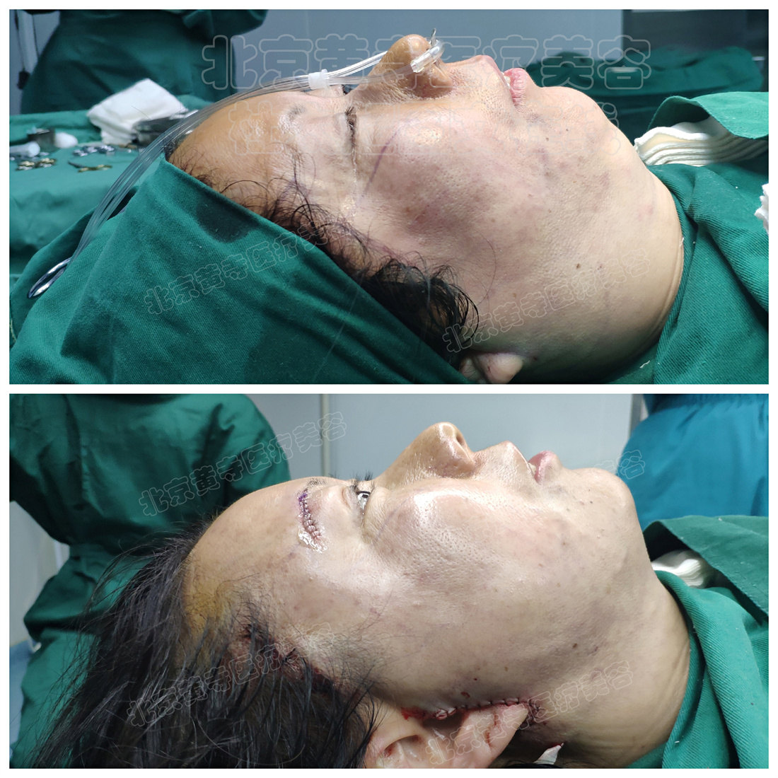 术前vs术后即刻