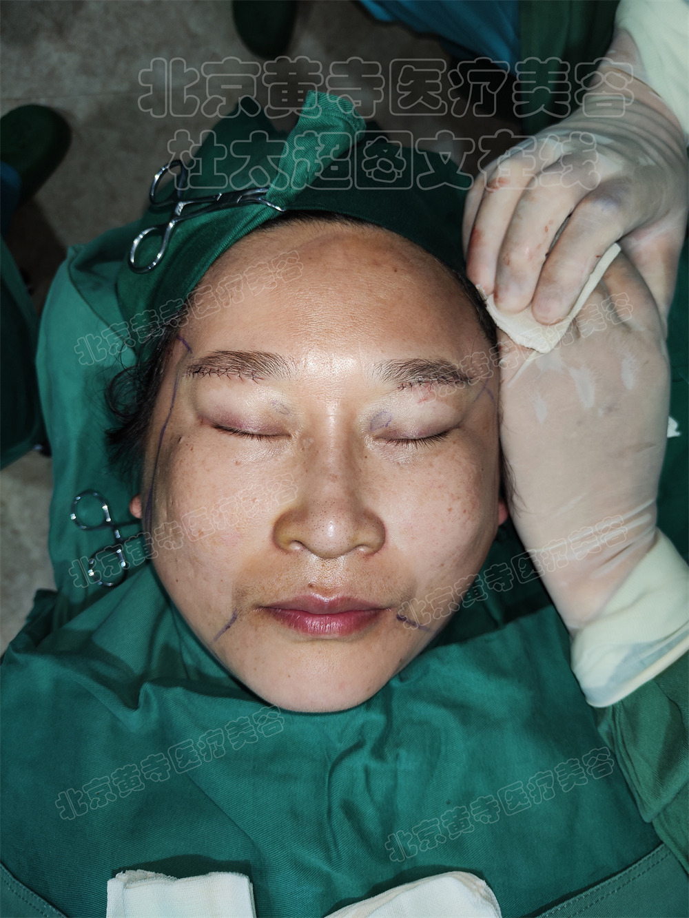 单侧拉皮即刻对比