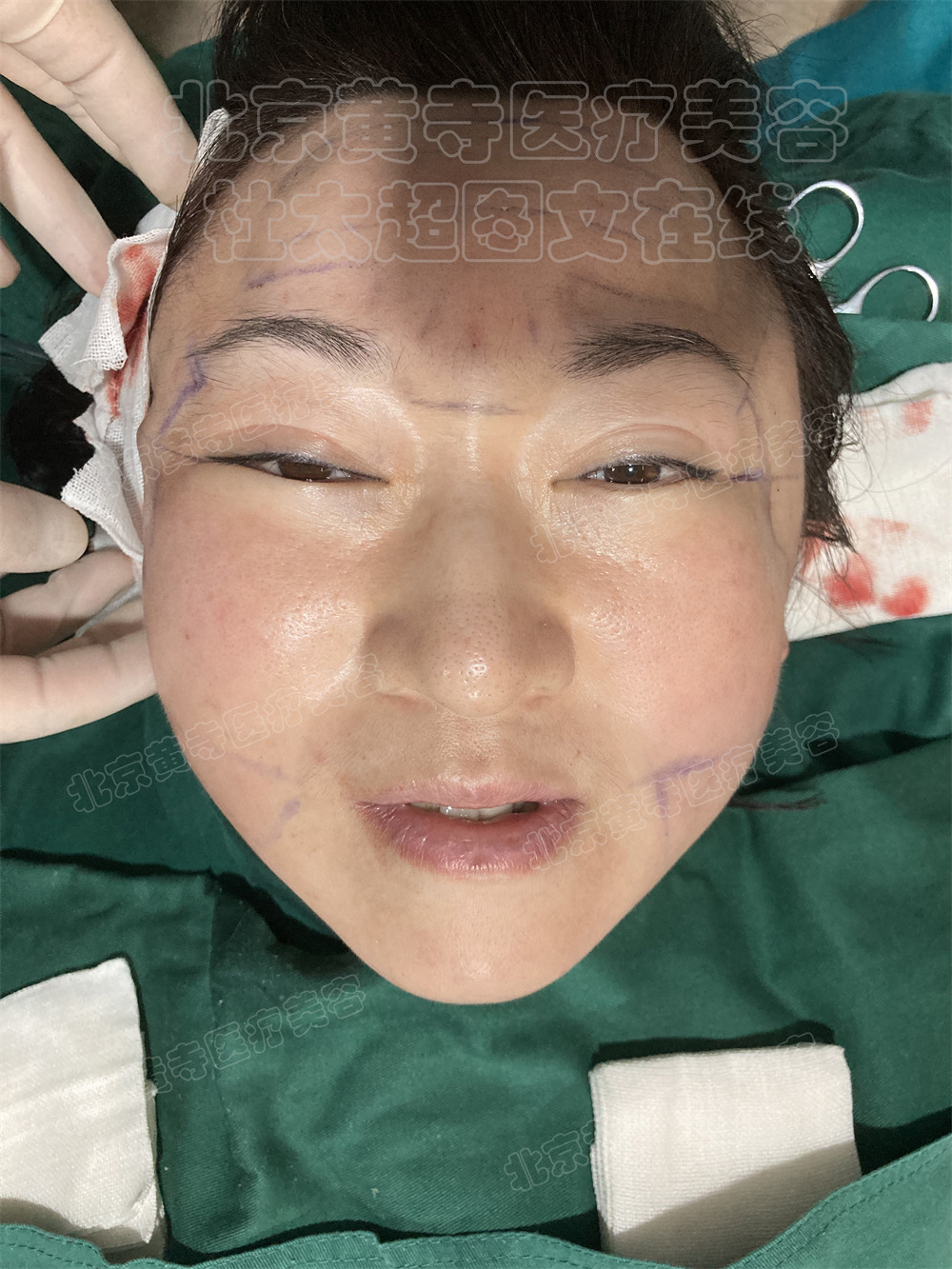 单侧拉皮即刻对比