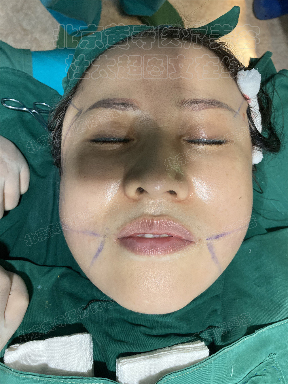 单侧拉皮即刻对比