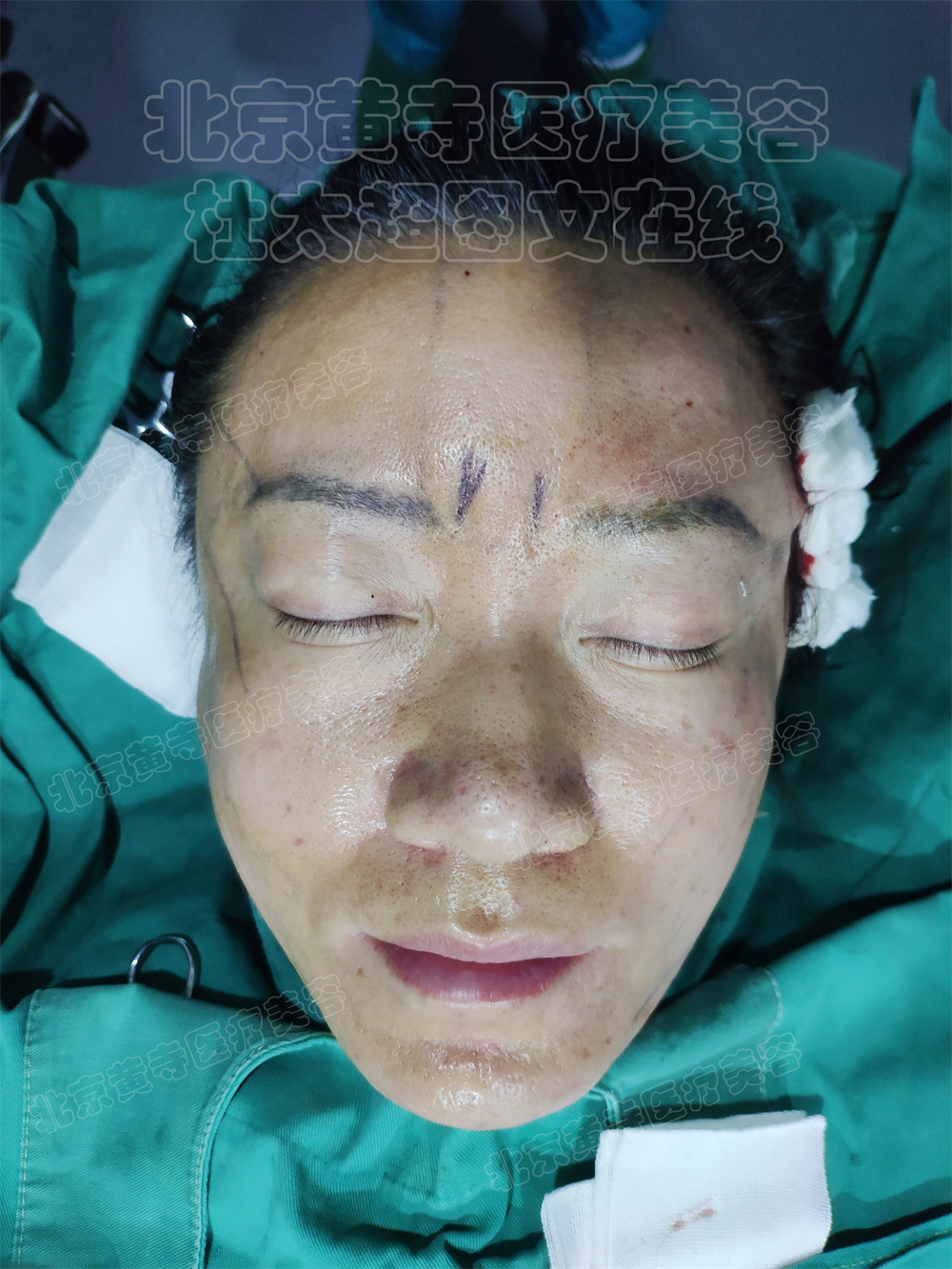 单侧拉皮即刻对比