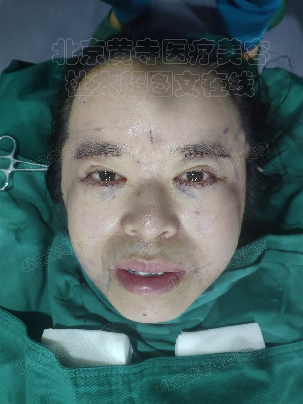 单侧拉皮即刻对比