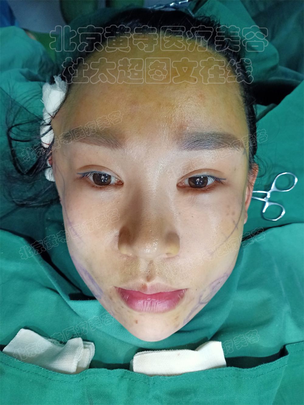 单侧拉皮即刻对比